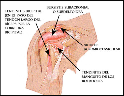 Tendinitis Bicipital - Causas
