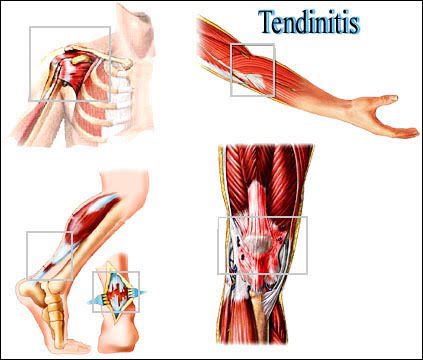 Resultado de imagen para Tendinitis y tenosinovitis